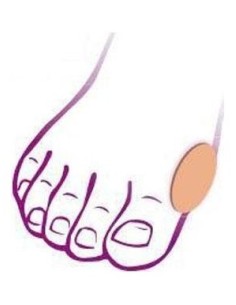 Comforsil Juanetes Parche Autoadherente 2Uds